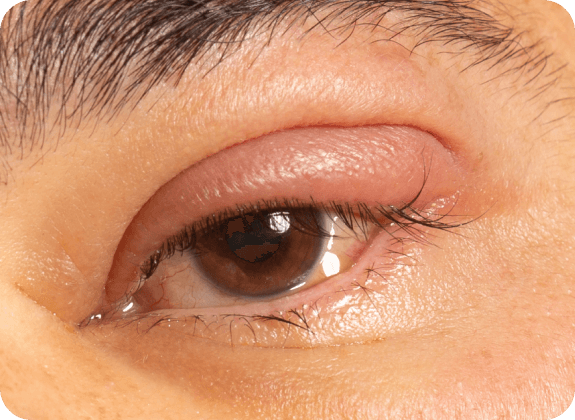 blepharitis