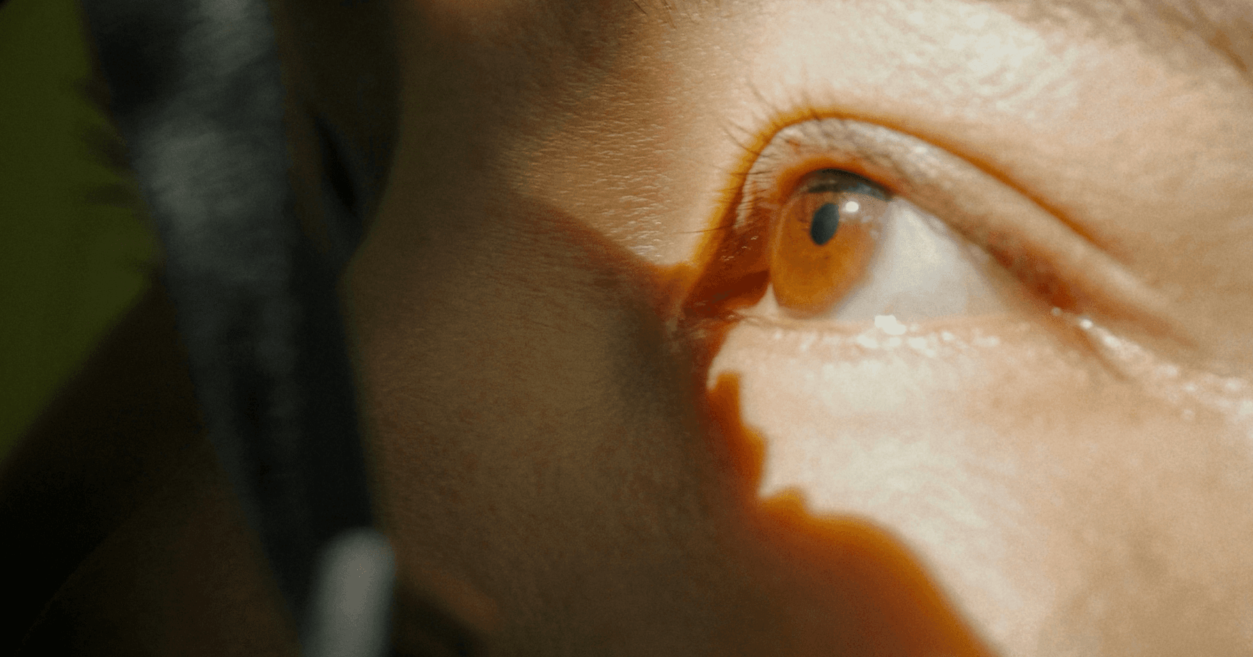 age-related macular degeneration