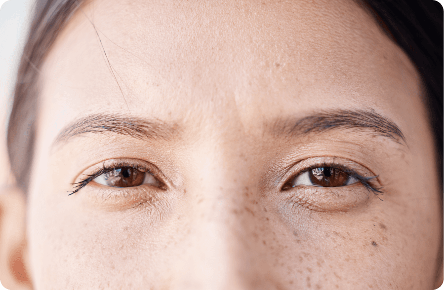 person with eyes showing macular degeneration risk factors