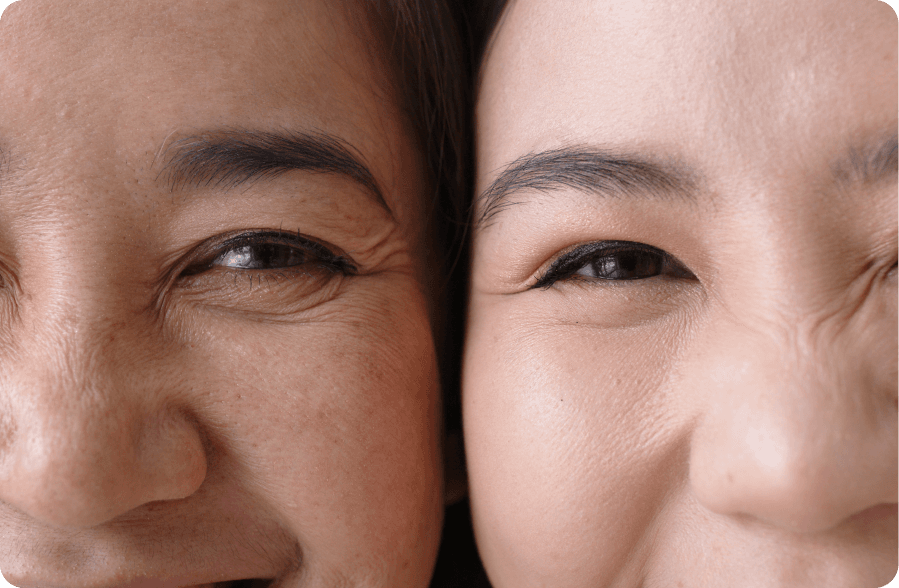 Mid-face and tear trough rejuvenation