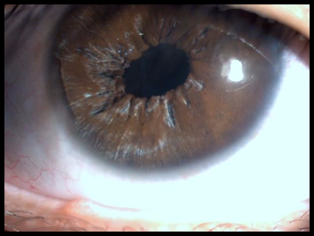 This picture was taken soon after the same patient had an hour-long surgery to repair the iris, and remove the cataract. The iris is repaired, and the pupil (which is the opening formed by the iris for light to enter the eye) is smaller. The patient now experiences less glare, and the images are much sharper.