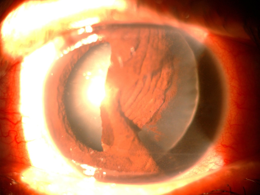 Another unfortunate industrial injury left this patient with severe iris trauma, with defects in multiple areas of his iris. His lens also started turning cloudy, and started to wobble every time his eye moved.