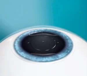 Graphic showing how the EVO ICL lens fits in the eye