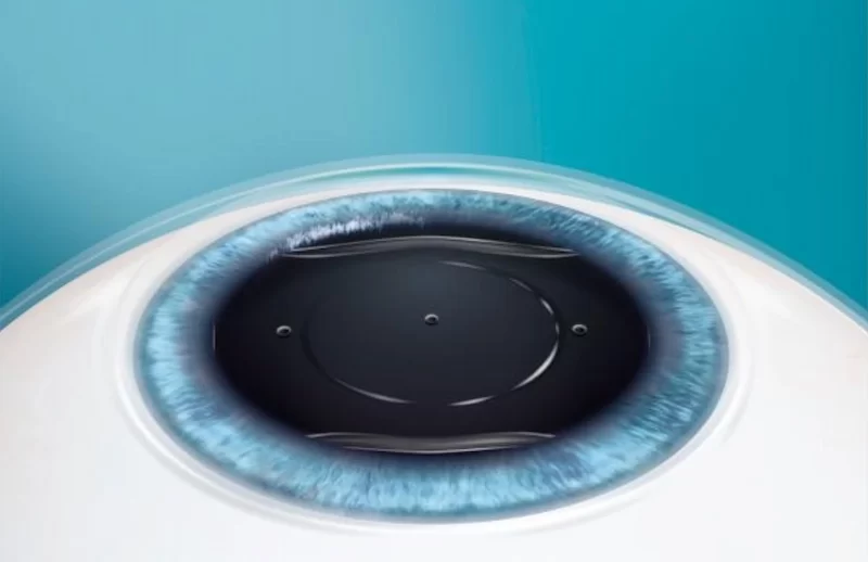 Graphic showing how the EVO ICL lens fits in the eye