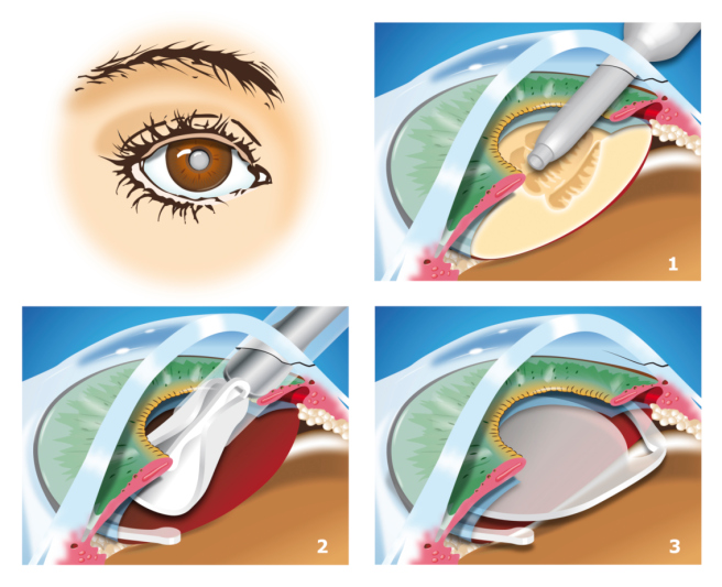 Traditional Cataract Surgery