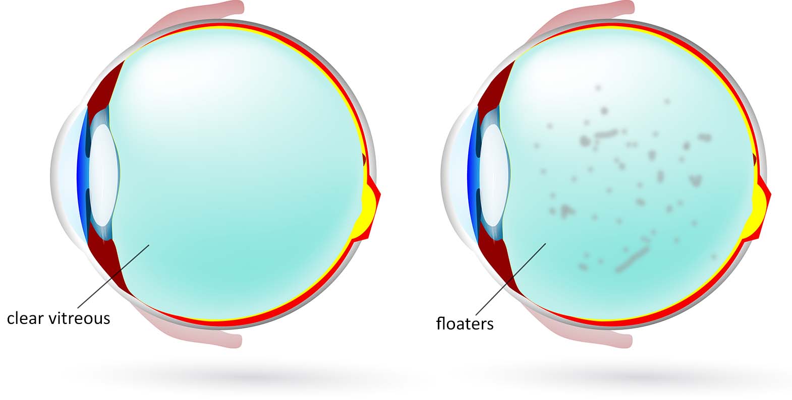 Normal Vs Floaters Photo