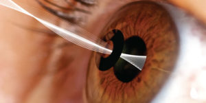 inlay-for-presbyopia